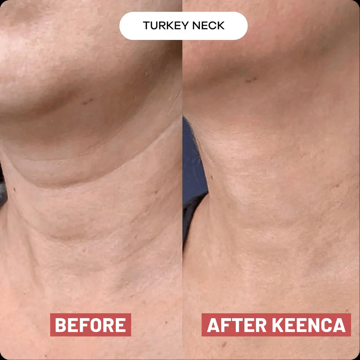 Keenca - Neck beauty patch